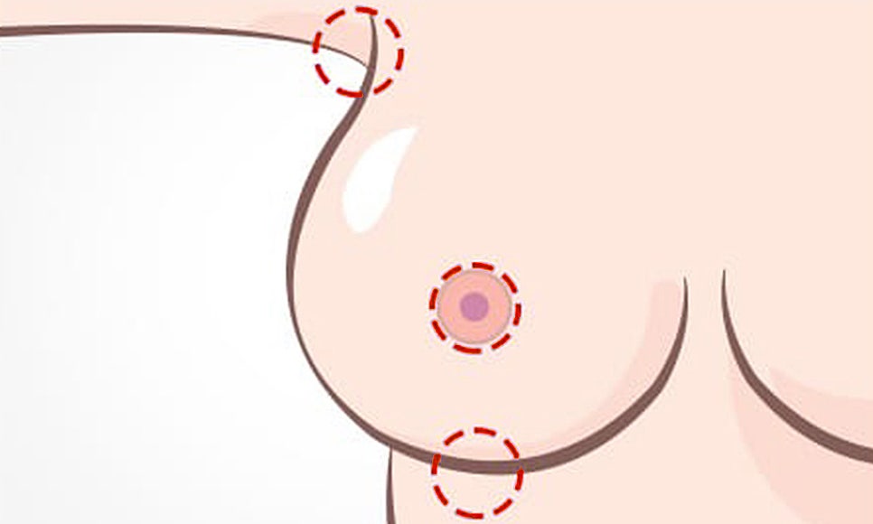 처진 가슴, 케이스에 따른 맞춤 개선으로 탄력 있고 볼륨감 있는 가슴으로! 관련 이미지 6