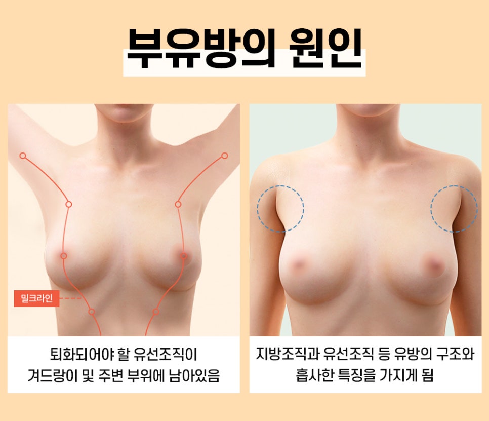 가슴부터 팔뚝까지 조화를 고려하는 부유방 수술 관련 이미지 3