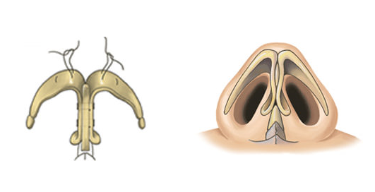 남자에게 맞는 코 성형과 개선 방법! 관련 이미지 5