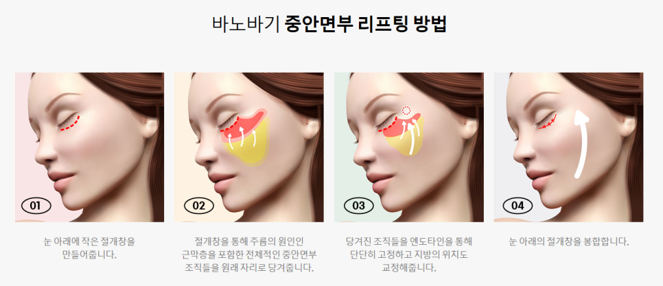 중안면부 리프팅으로 눈 밑 주름, 팔자주름까지 한 번에! 관련 이미지 2