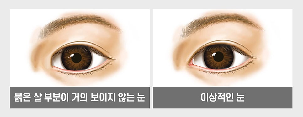답답한 눈매를 또렷하고 시원하게 개선할 수 있는 트임 성형 방법! 관련 이미지 4