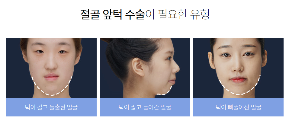 작은얼굴의 핵심은 앞턱수술을 어떻게 깎는가입니다. 관련 이미지 8