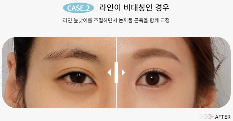 예쁜 눈매를 되찾는 방법, 눈 재수술 관련 이미지 4