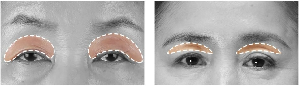 내시경 엔도타인 이마 리프팅으로 더욱 밝아지는 인상! 관련 이미지 3