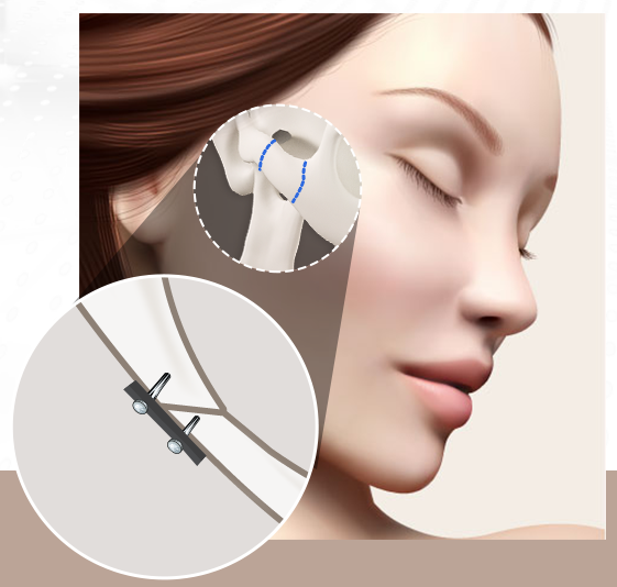 광대축소술로 작고 부드러운 얼굴형 GET! 관련 이미지 4