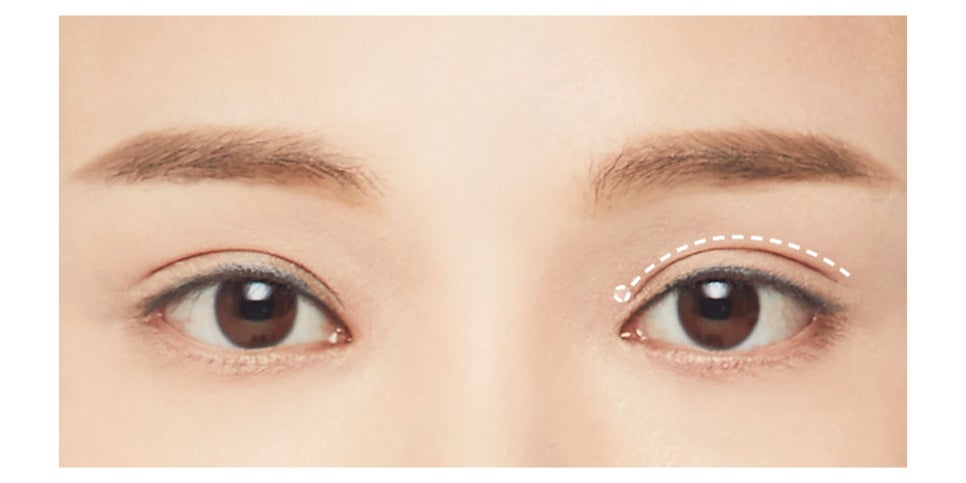 절개 쌍꺼풀, 원하는 라인으로 흉터 걱정 없이 한 번에 개선 관련 이미지 5