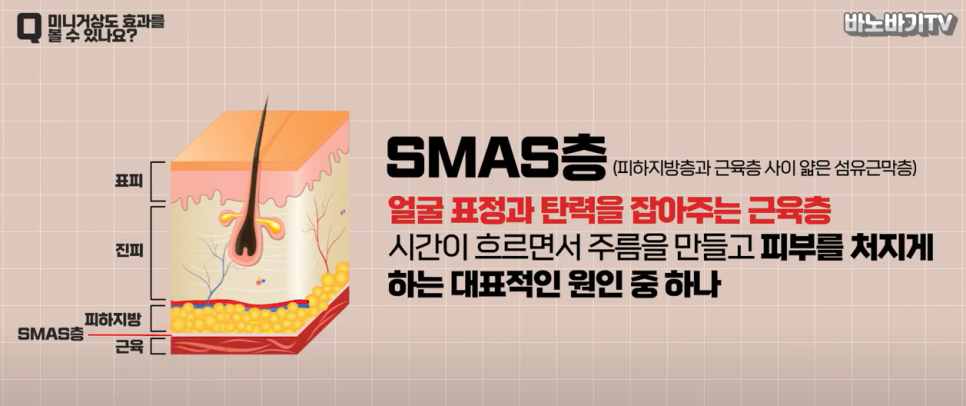 미니거상을 받아야 하는 시기는 언제일까요? 관련 이미지 2