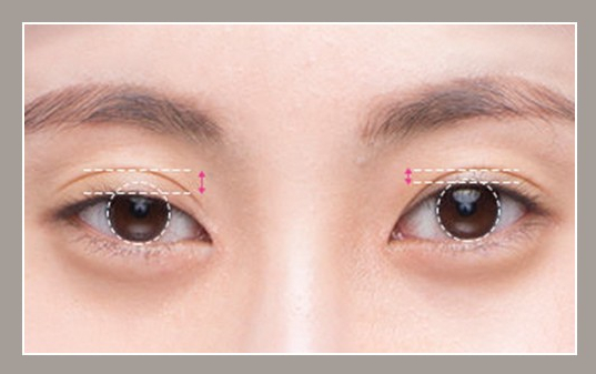 눈 재수술의 다양한 원인과 재수술 방법 관련 이미지 4