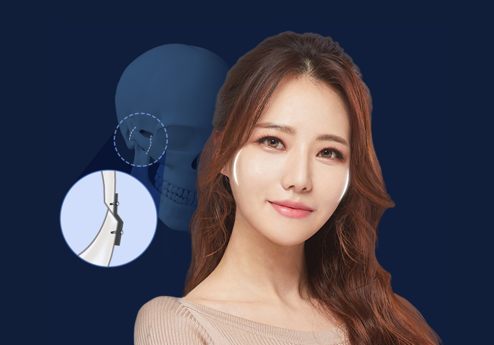 광대축소전후 22년 경력의 전문의의 실력, 궁금하신가요? 관련 이미지 3