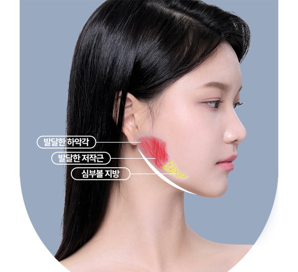 사각턱 수술, 획일화된 V라인 대신 나에게 맞는 라인으로 관련 이미지 2