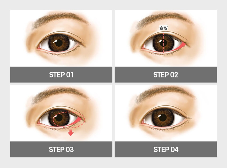 답답한 눈매를 또렷하고 시원하게 개선할 수 있는 트임 성형 방법! 관련 이미지 7