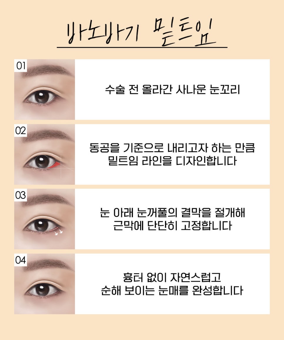 트임  성형, 얼굴에 맞는 조화로운 눈의 비율과 시원한 눈매로 개선 관련 이미지 5