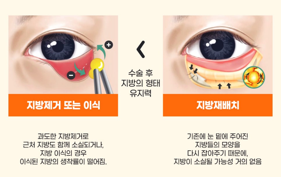 다크서클, 눈 밑 꺼짐, 눈 밑 주름 눈밑지방재배치로 한 번에 개선! 관련 이미지 3