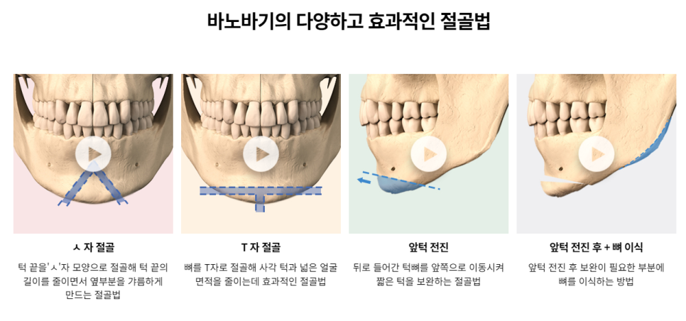 작은 얼굴을 결정짓는 선명한 라인, 절골 앞턱수술 관련 이미지 3