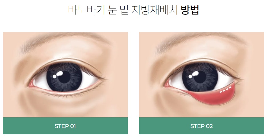 눈밑지방재배치유명한곳 경력을 봐야 실력을 압니다. 관련 이미지 4
