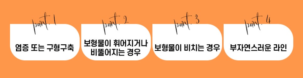 첫 코 수술, 바노바기 코 성형으로 콧대부터 코끝까지! 관련 이미지 2