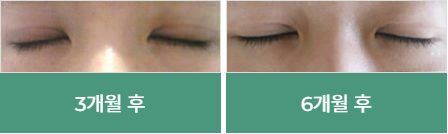 바노바기 절개 눈매교정 알아보기! 관련 이미지 4