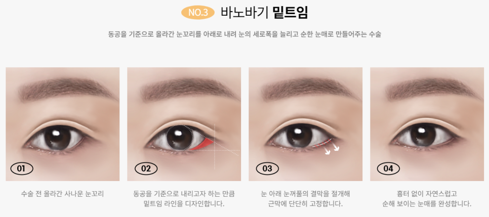 내 눈의 숨겨진 1mm를 찾아내다! 바노바기 트임성형 관련 이미지 5
