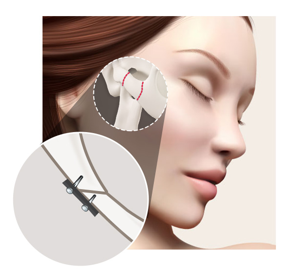 광대축소, 많이 깎는다고 갸름해질까요? 관련 이미지 4