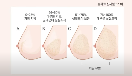 유방외과 전문의가 말하는 유방검진을 받아야 하는 이유 관련 이미지 2