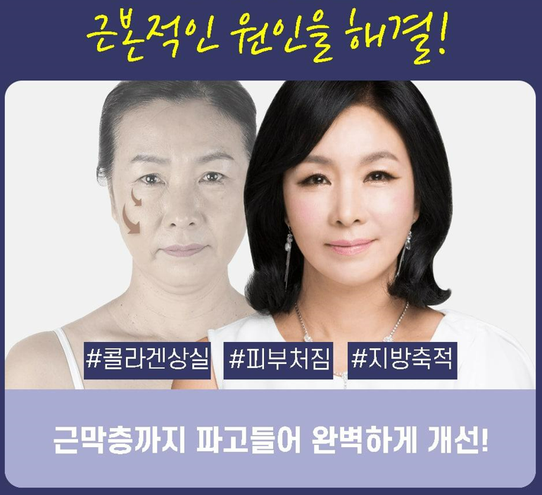 하안면부 노화는 근본적인 원인을 해결해야 한다! 관련 이미지 1
