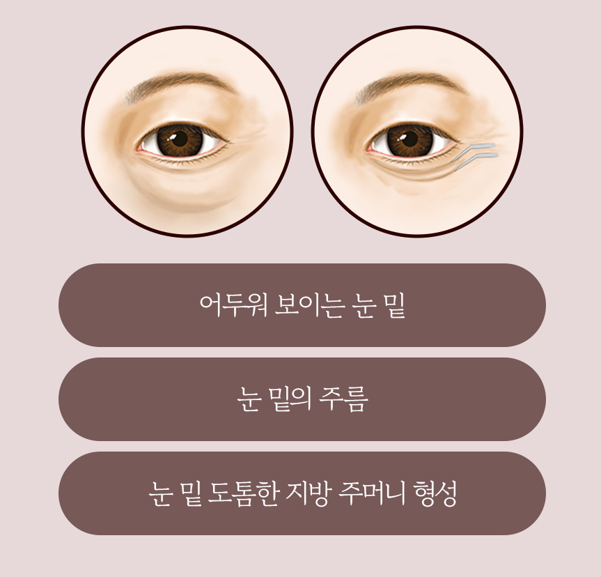 하안검이 필요한 경우, 그리고 개선 효과는? 관련 이미지 2