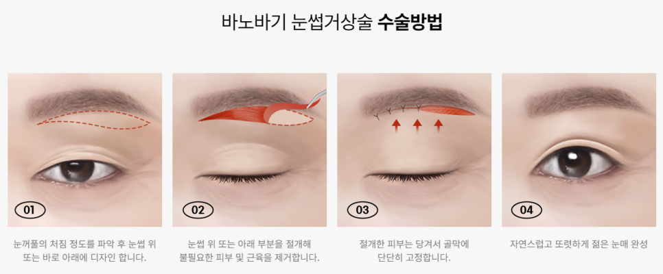 자연스럽게 눈가 처짐을 개선하는 바노바기 눈썹거상술! 관련 이미지 3