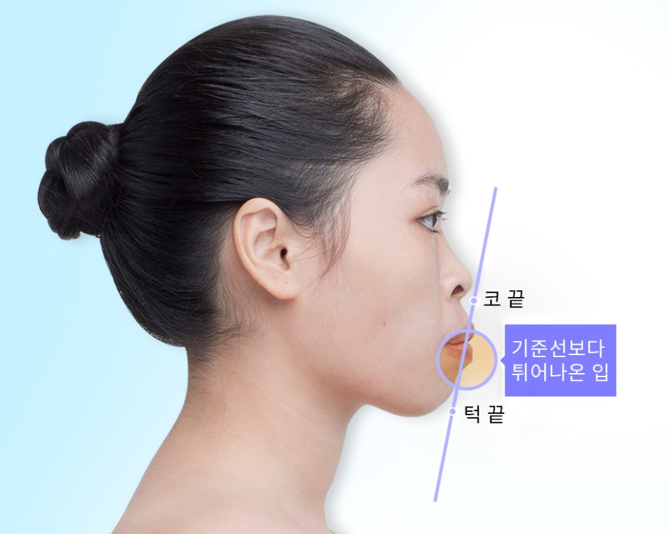 유형에 따라 달라지는 돌출입 수술 방법 관련 이미지 4