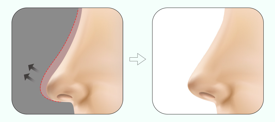 코 재수술! 원인에 따라 달라지는 수술법 관련 이미지 4