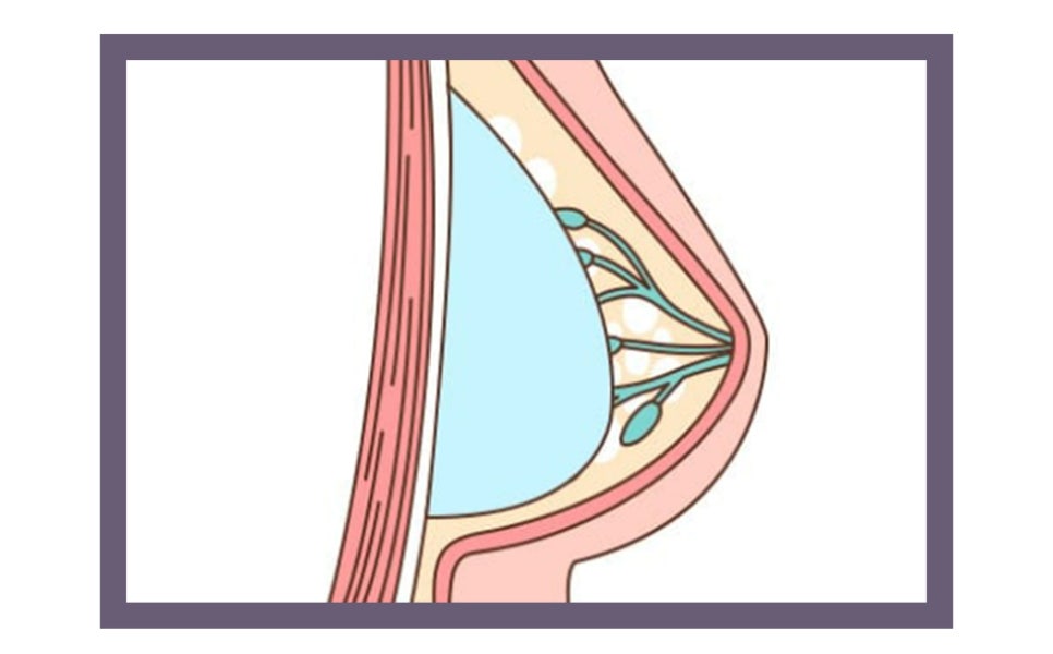 유방암 치료 후 가슴 재건 시기와 수술 방법 관련 이미지 5