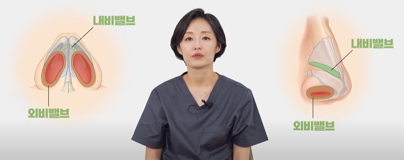 비밸브협착증, 코 막힘의 원인은? 관련 이미지 4