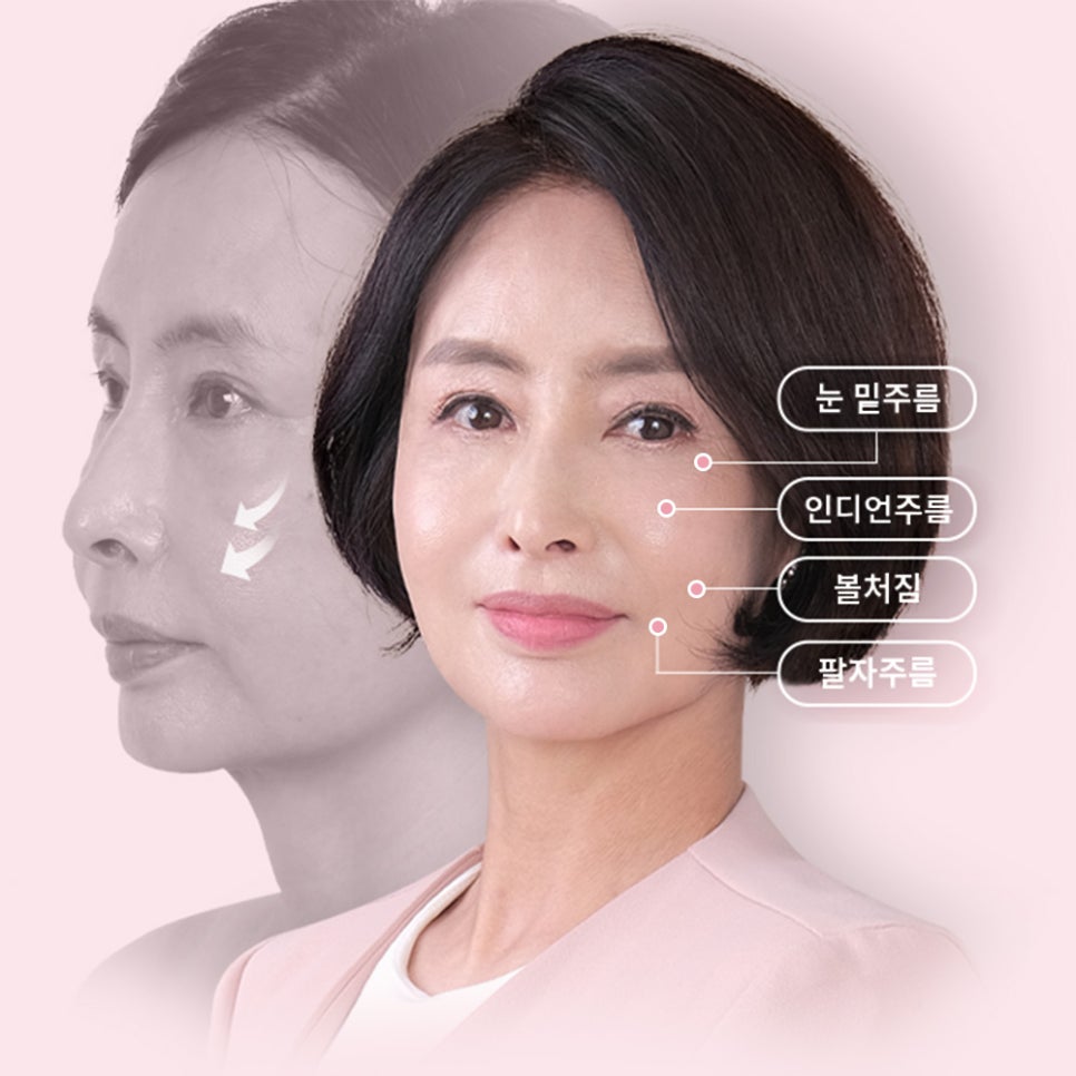 중안면부 리프팅 수술법과 엔도타인의 장점 관련 이미지 2