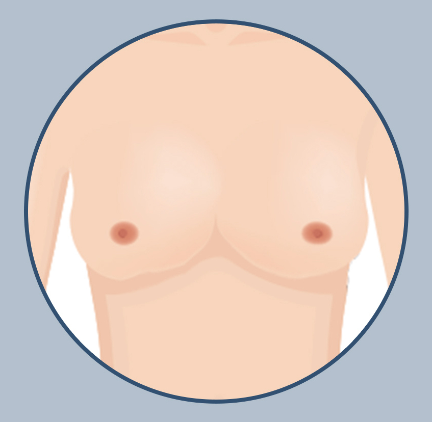 가슴 재수술, 원인에 맞는 정확한 수술법과 후 관리가 중요한 이유! 관련 이미지 7