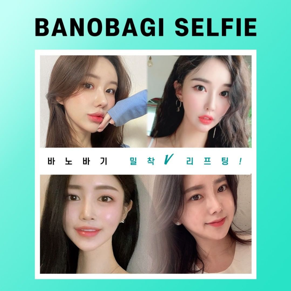 이중턱지방흡입과 민트실리프팅을 한번에 하면 그 효과는? 관련 이미지 9