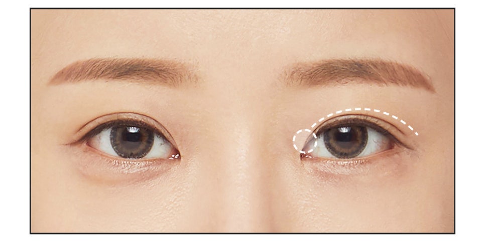 절개 쌍꺼풀의 수술법과 절개법이 필요한 경우 관련 이미지 7