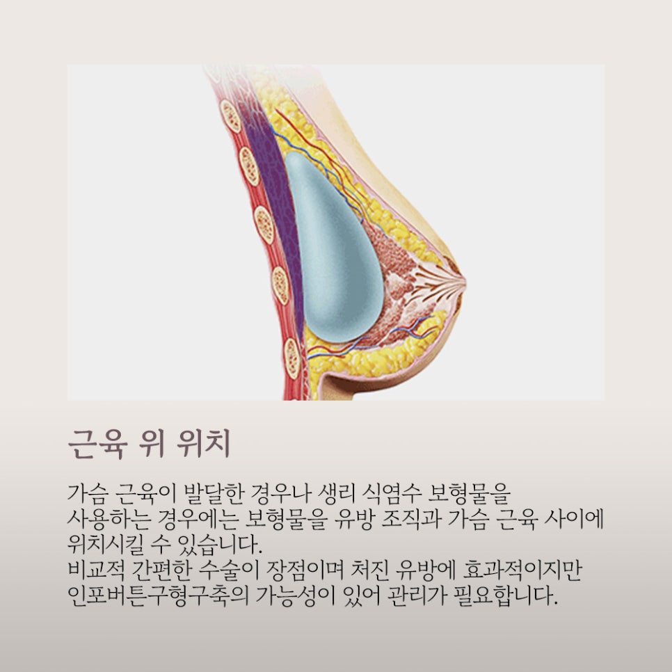 가슴 성형, 보형물의 종류와 절개법의 장단점 관련 이미지 10