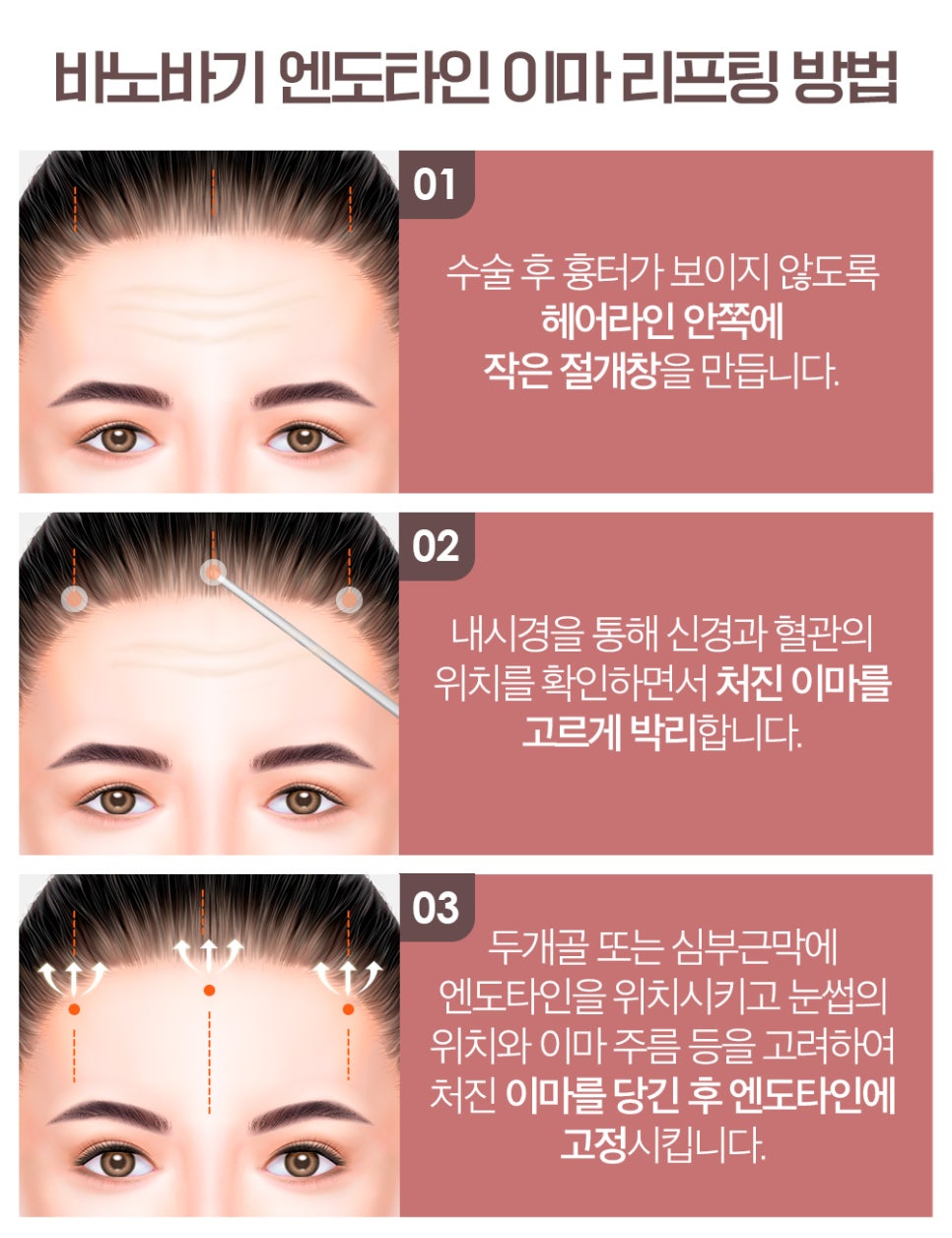 엔도타인 이마 리프팅이 필요한 경우와 수술 방법 관련 이미지 5