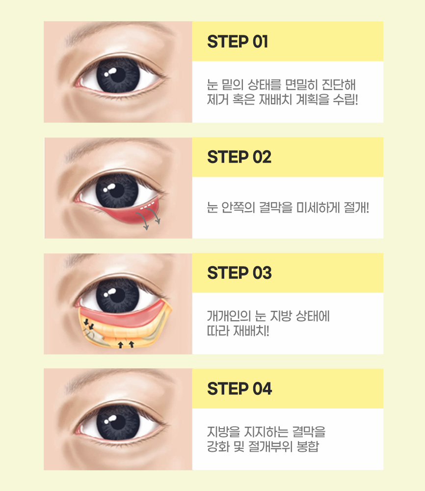 눈 밑 지방재배치로 다크서클, 눈 밑 주름 개선할 수 있습니다. 관련 이미지 4