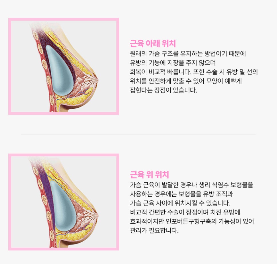 가슴 확대술, 최적의 보형물로 아름다운 가슴 형태를 만들어야 합니다. 관련 이미지 5