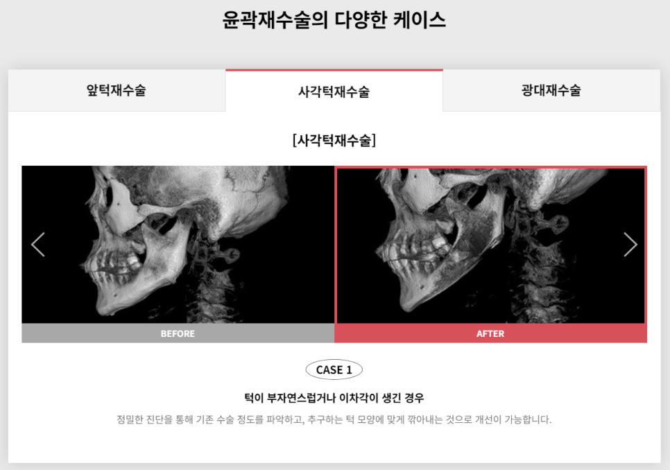 다시 되찾는 아름다운 미소! 윤곽재수술 관련 이미지 4
