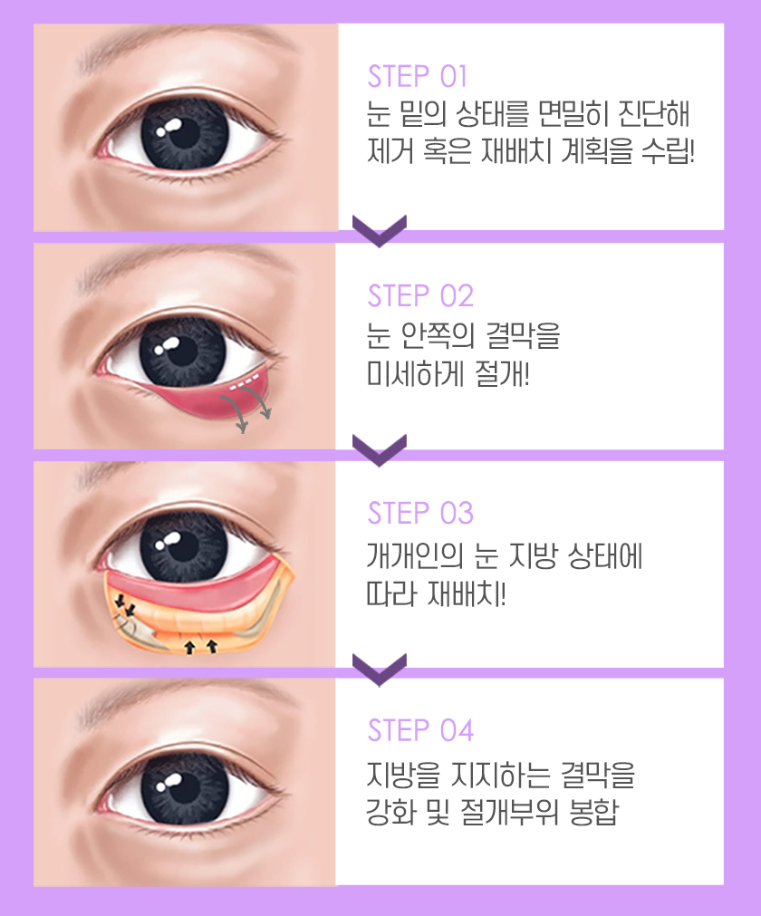 어두운 눈가를 개선하는 눈 밑 지방재배치의 장점과 수술법 관련 이미지 2