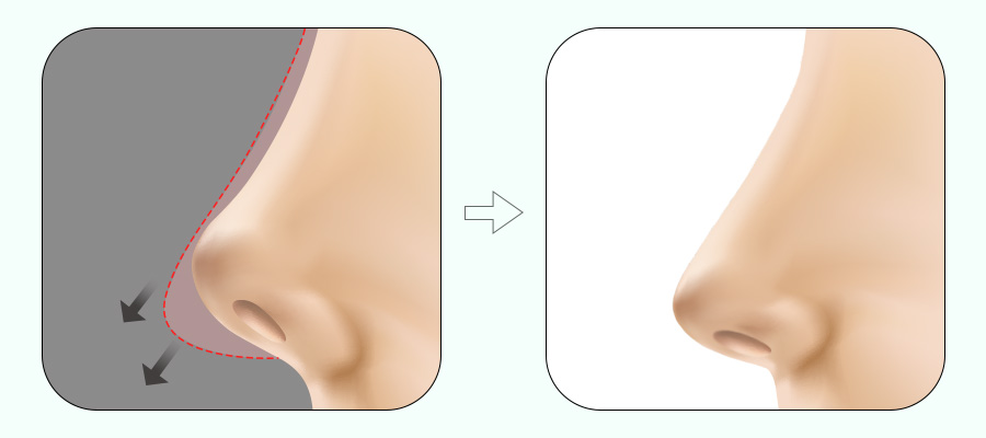 코 재수술! 원인에 따라 달라지는 수술법 관련 이미지 5