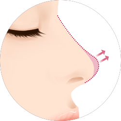 코재수술비용 코재수술병원 바노바기는 제대로 합니다! 관련 이미지 4