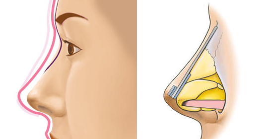 남자에게 맞는 코 성형과 개선 방법! 관련 이미지 4