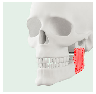 사각턱 수술 방법이 나뉘는 이유와 나에게 맞는 수술법은? 관련 이미지 6