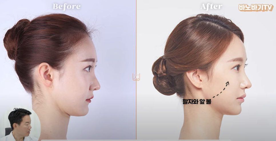 아테콜 필러의 장점과 아테콜 추천 부위는?! 관련 이미지 8