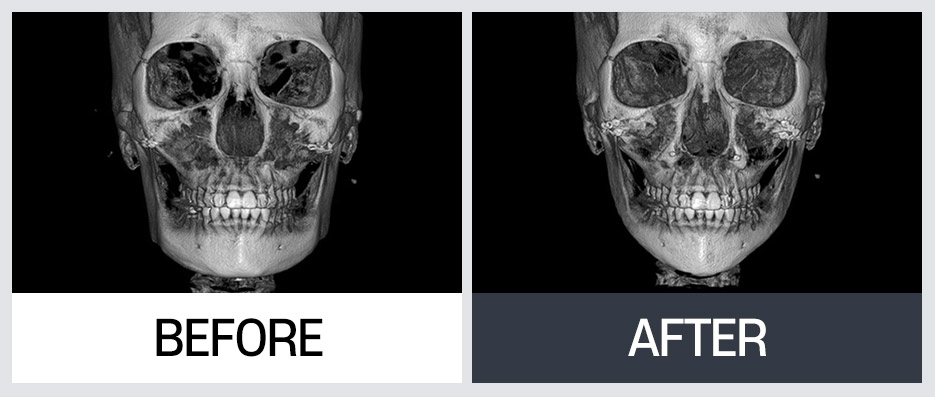 윤곽 재수술의 다양한 케이스와 수술 방법 관련 이미지 6