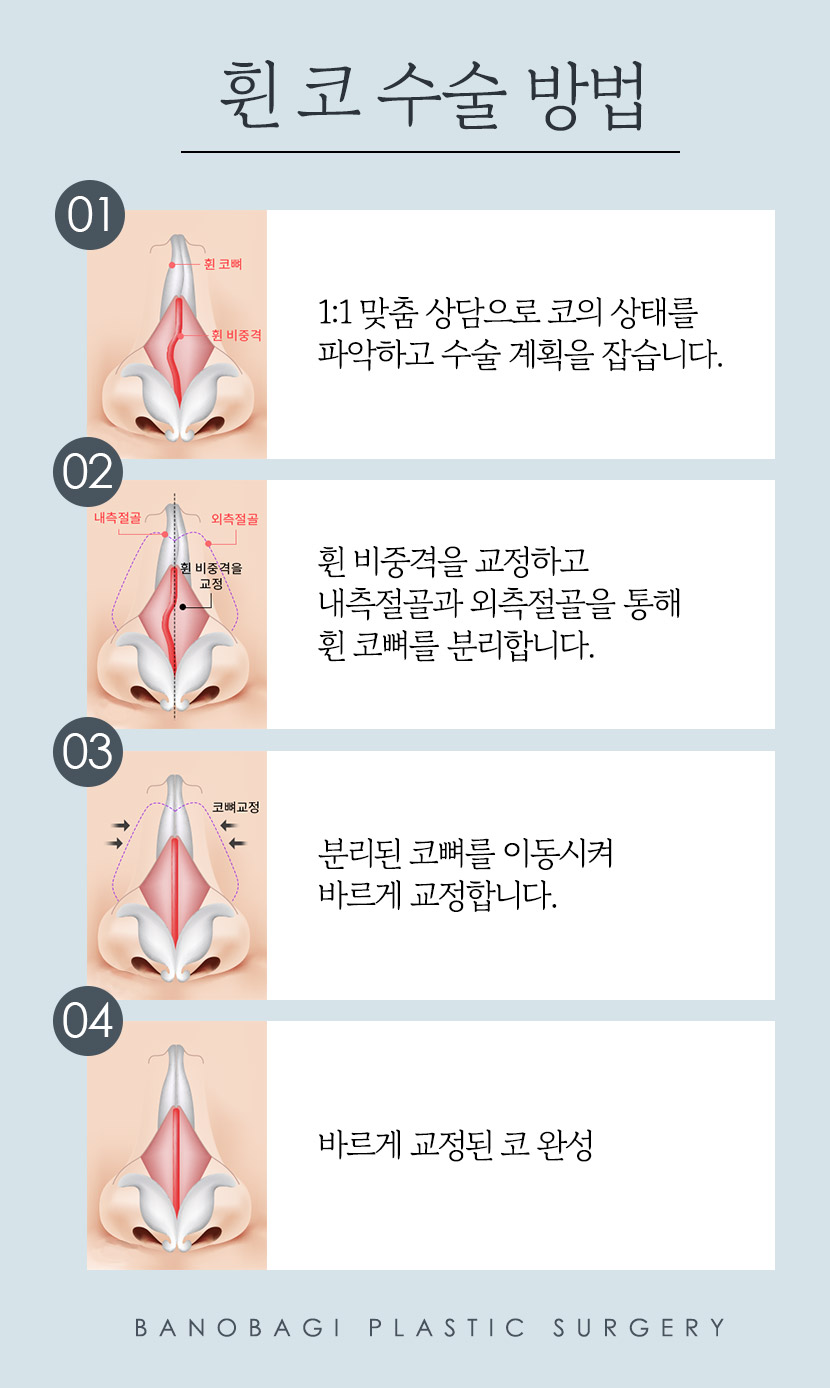남자 코성형, 코 라인에 따라 달라지는 수술 방법 관련 이미지 6