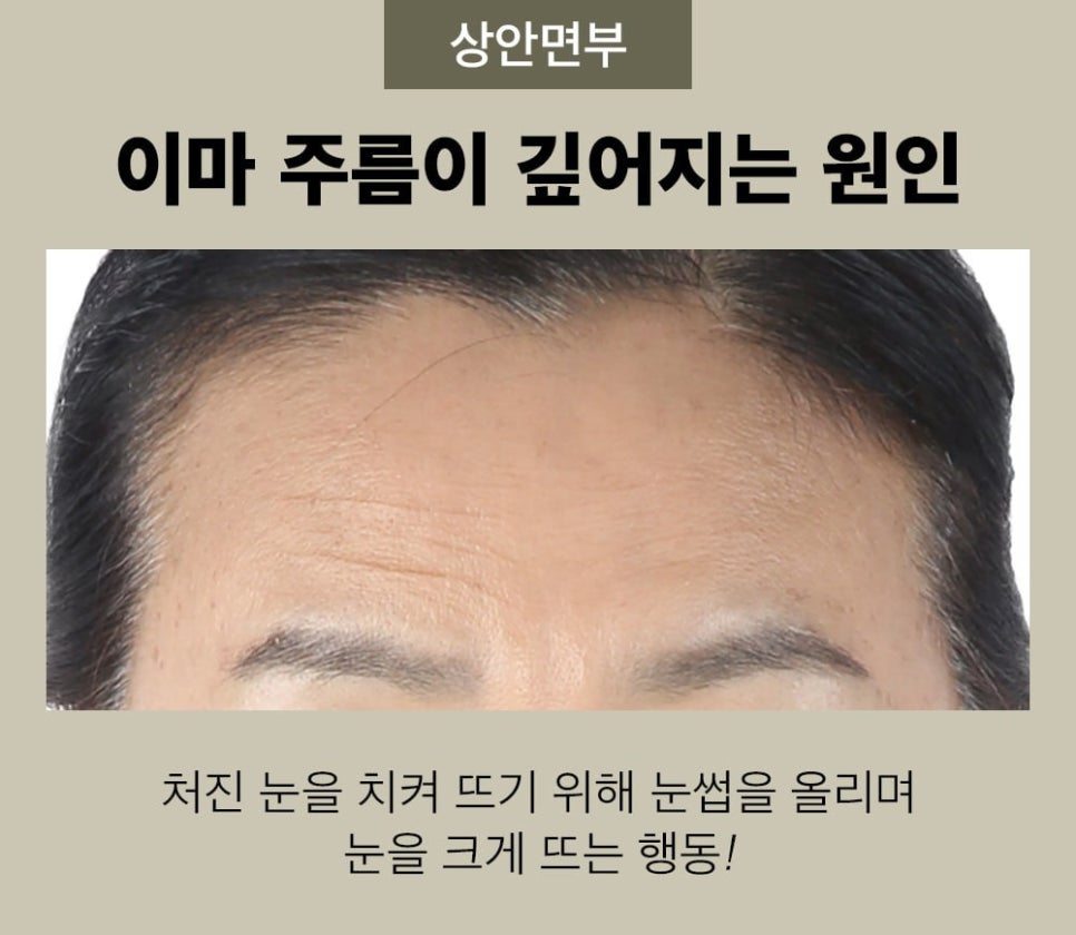 처지고 주름진 이마, 엔도타인 이마 리프팅으로 개선 관련 이미지 2