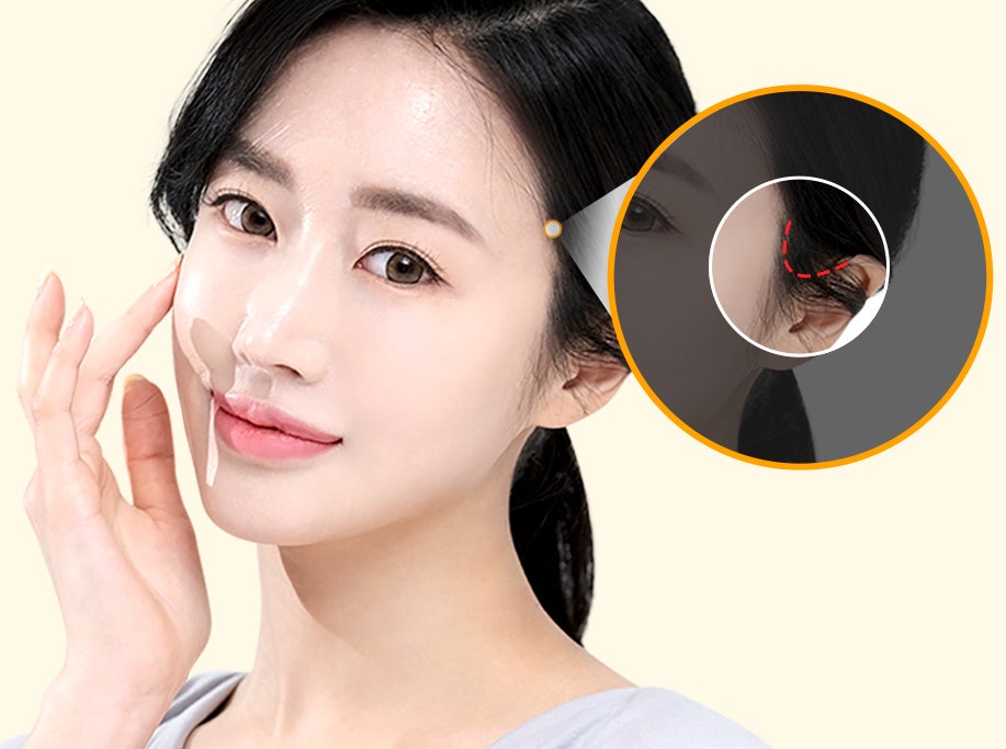 뼈 수술 없이 얼굴형 개선이 가능한 바노바기 미니V리프팅 관련 이미지 4